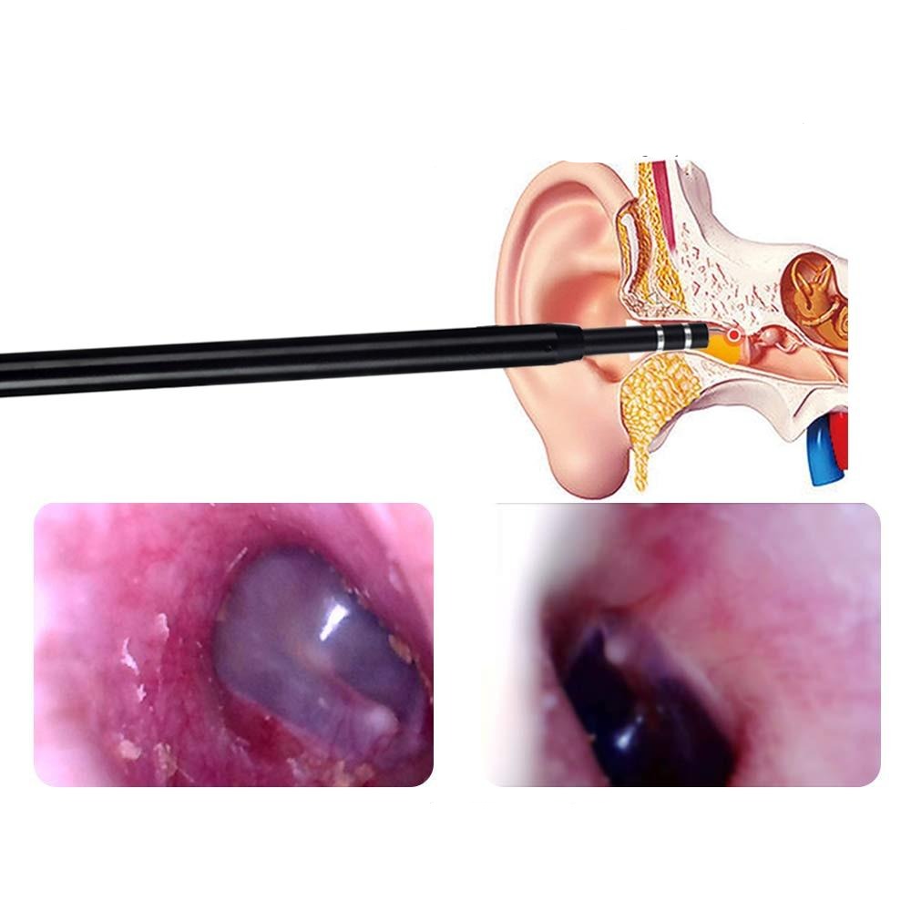 Live Ear Medical ear endoscope.